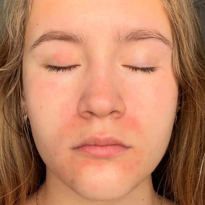 When My Skin Said “Enough”: What an Irritation Flare-Up Taught Me
