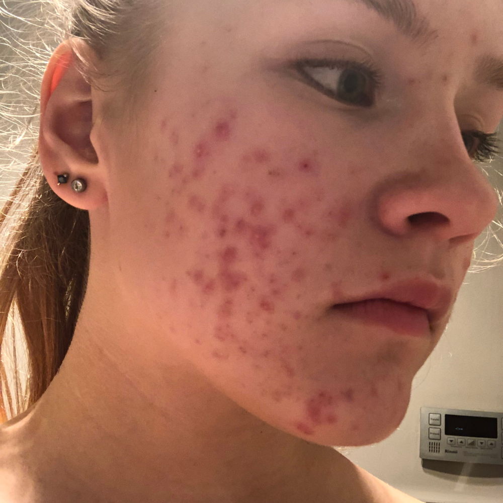 The Day I Stopped Fighting My Skin