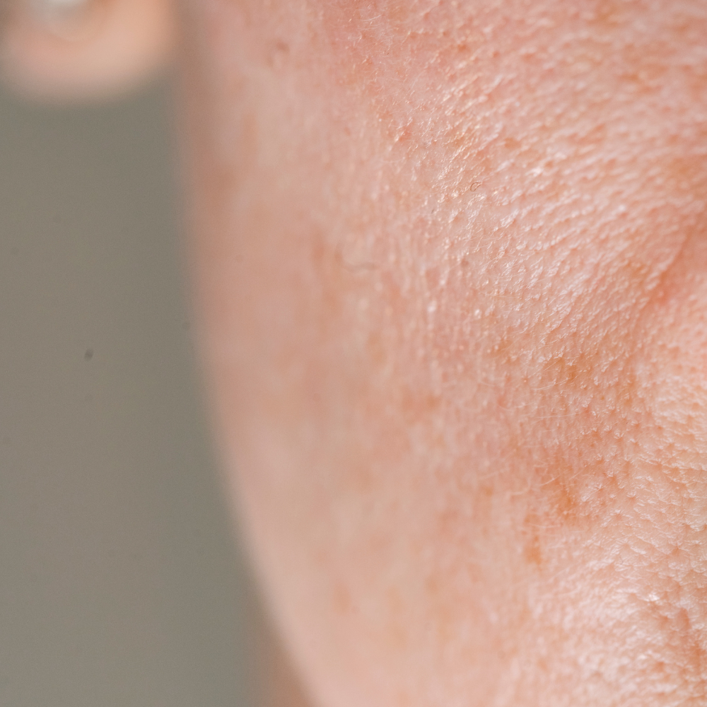 When Your Skin Is Healing, Not Breaking Out