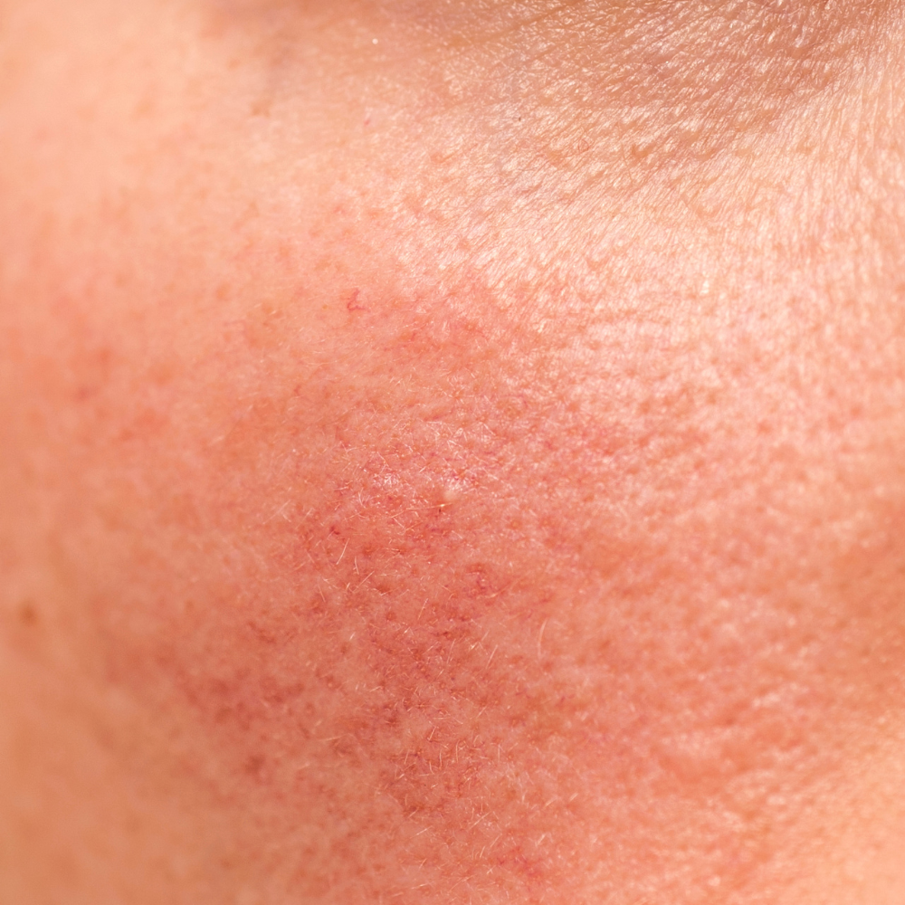 Why Your Skin Turns Red: From Barrier Stress To Microbiome Imbalance