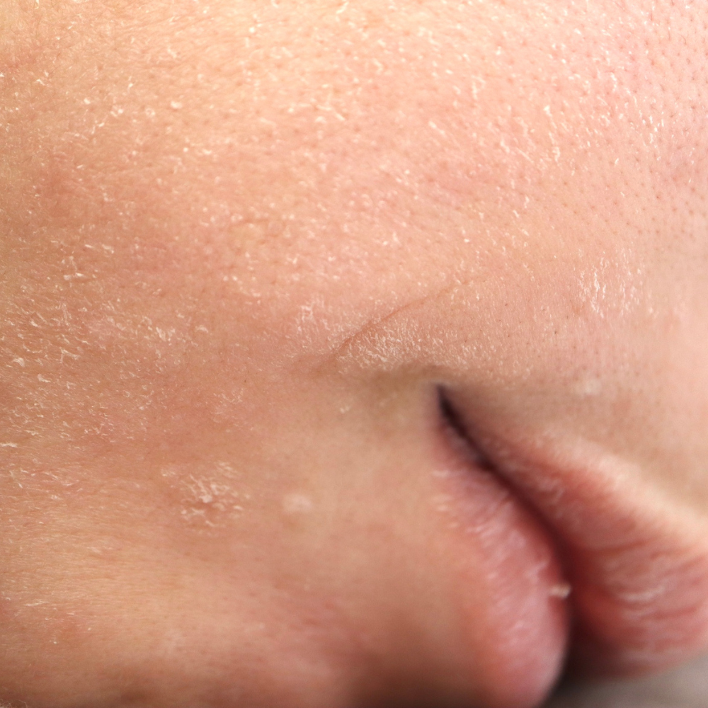 Dry Skin vs Dehydrated Skin: Why Your Moisturiser Matters for Both
